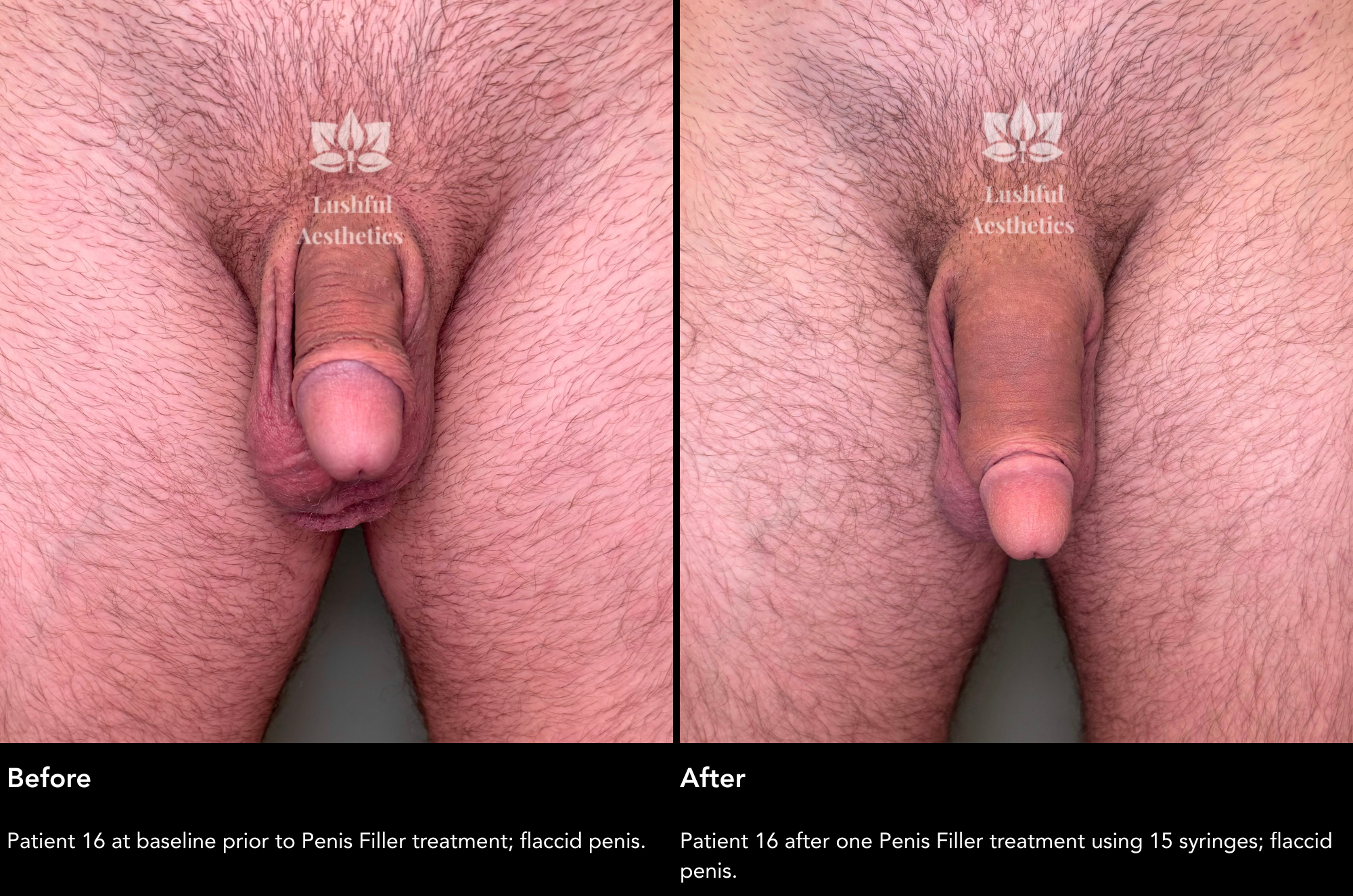 Before and After Case 16